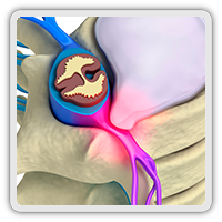 Disc injury treatment Whittier CA
